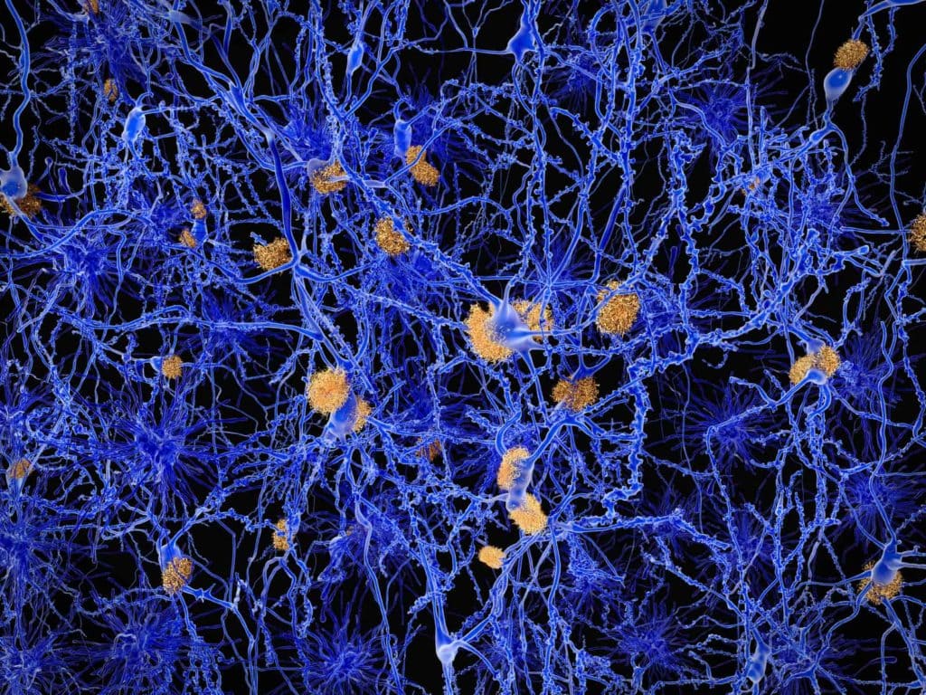 Alzheimer's